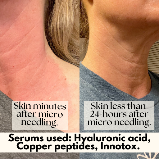 skin just minutes after micro needling compared to skin 24 hours later