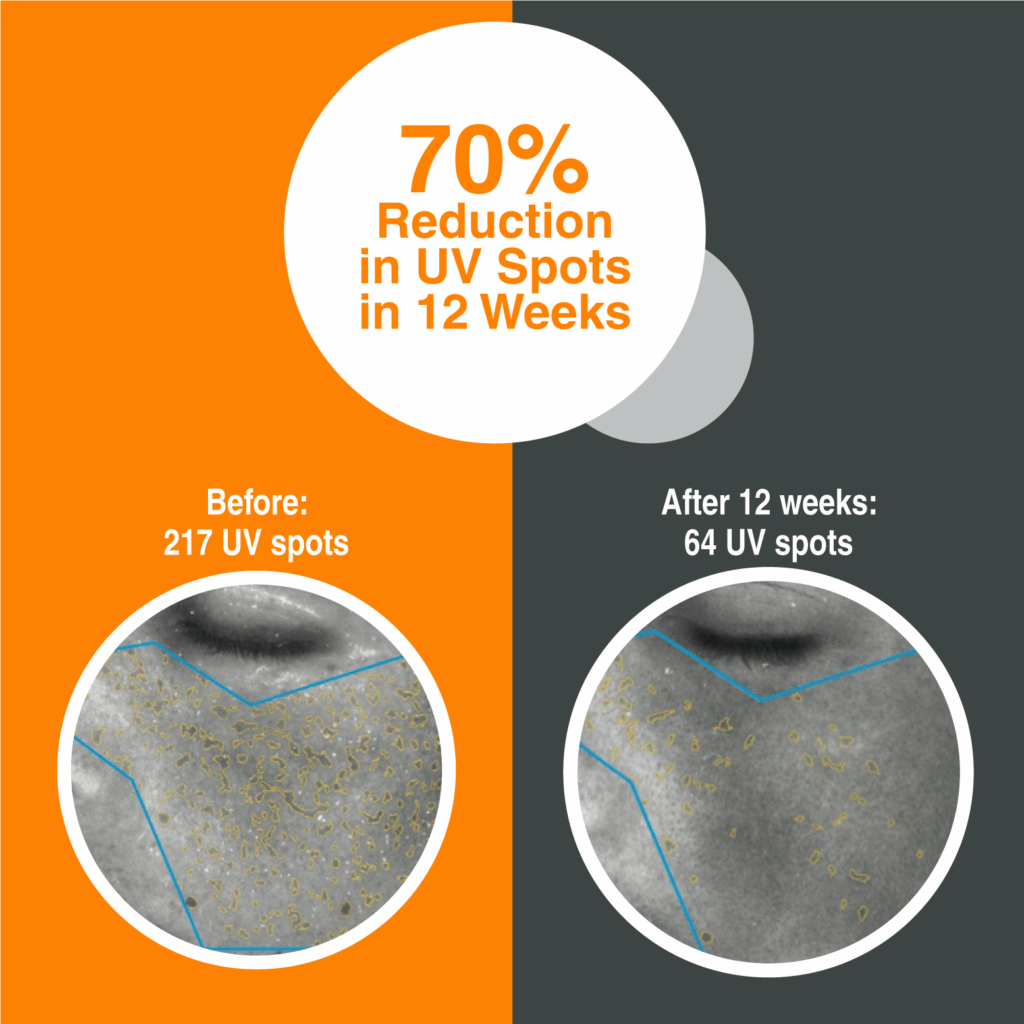 70% Reduction in UV Spots in 12 Weeks