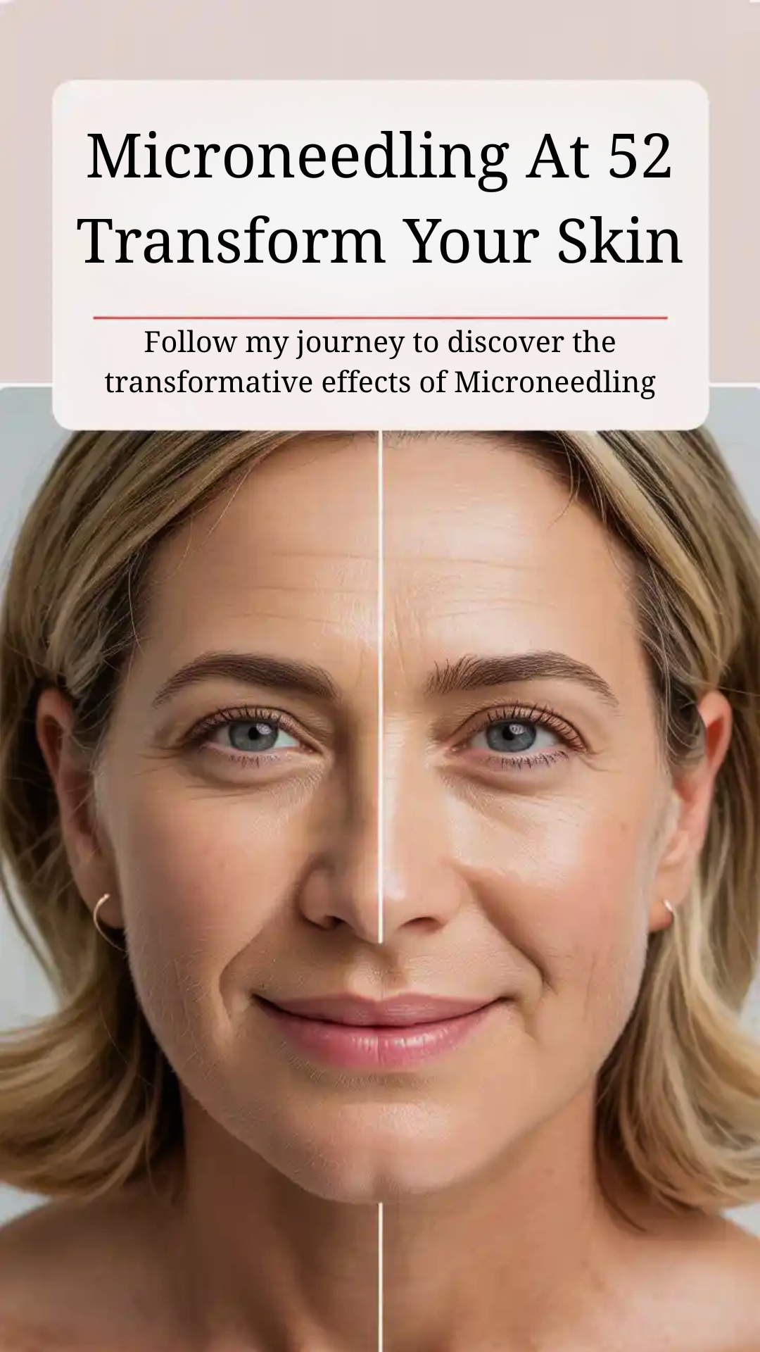 Microneedling at 52. Transform your skin. Follow my journey to discover the transformative effects of microneedling